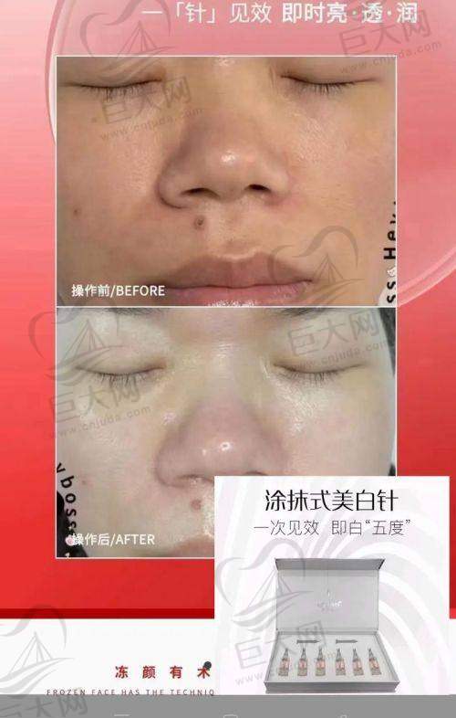 医美轻薄针是什么？打完几天出效果？打三年成效图显示馒化脸修复好，且无加速衰老危害