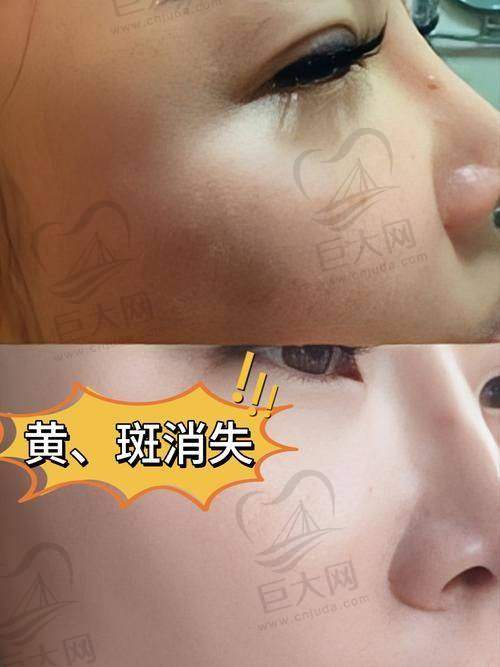 轻薄针成效分析