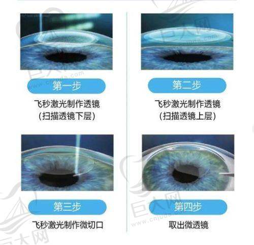 北京普瑞华德眼科医院怎么样？实力背景强、诊疗出色、设备先进，值得患者选择