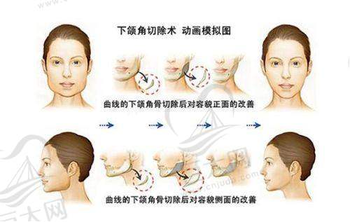 吸脂手术优势明显