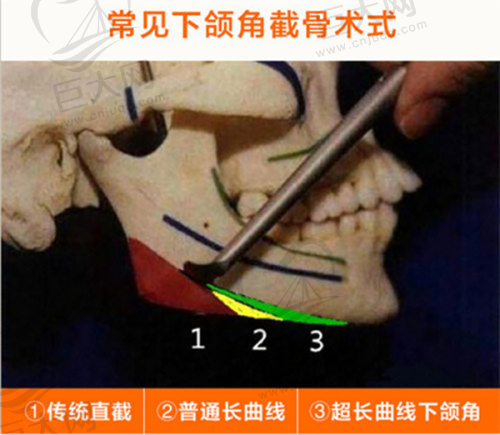 除了玻尿酸，蒋铮铮还会建议哪些医美项目？
