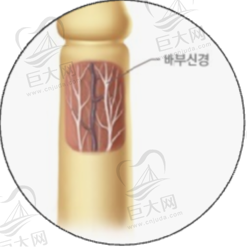 隐痕双眼皮优势明显