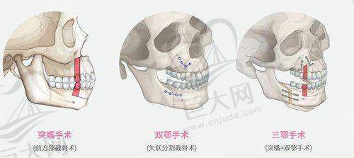 思伊美与其他玻尿酸品牌对比