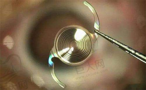 专精医生团队保护手术成功