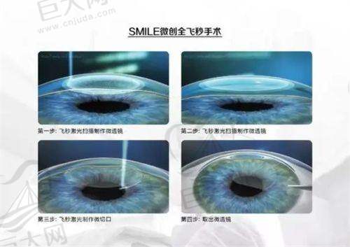 不同年份近视手术价格详情