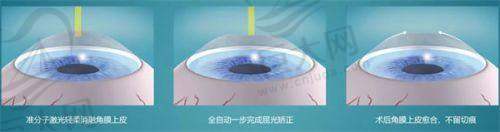 常见近视手术价格多样