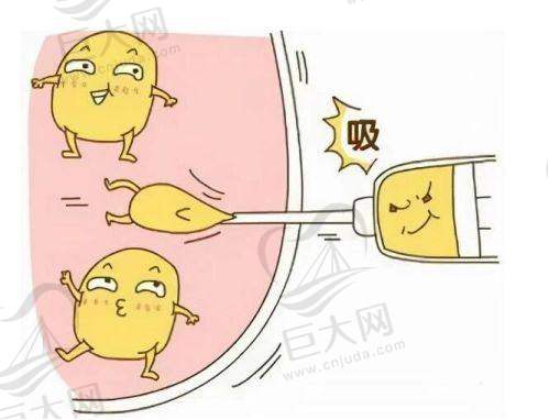 术后3-6个月：稳定期，手感接近自然