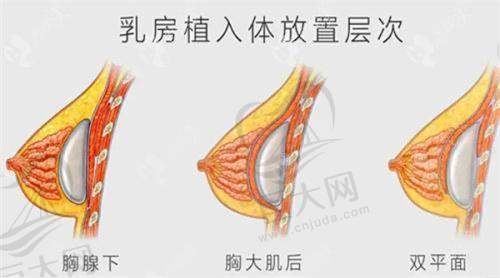 傲诺拉星熠隆胸变软需要多长时间？