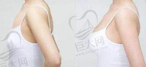 傲诺拉假体隆胸医生推荐