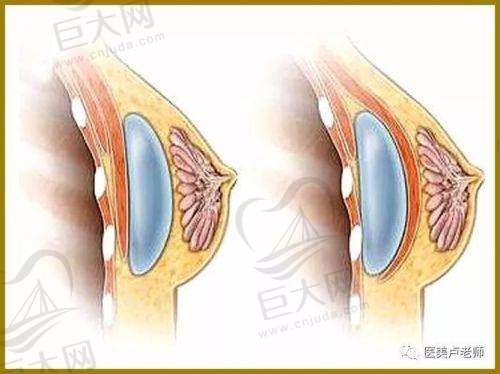 价格参考：傲诺拉星熠隆胸费用