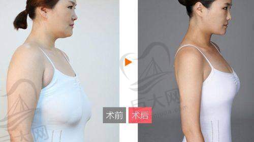 三等甲医院傲诺拉隆胸价格参考