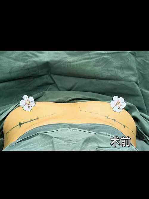 傲诺拉星熠假体按摩的正确方法
