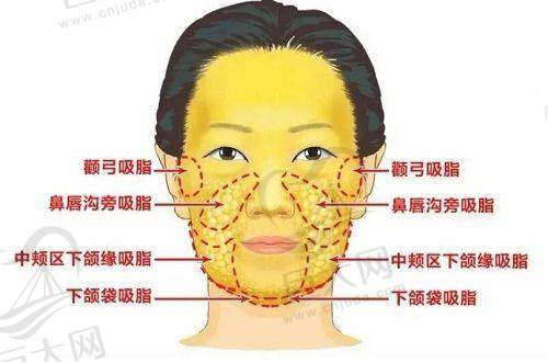 厚鼻翼相关项目及收费