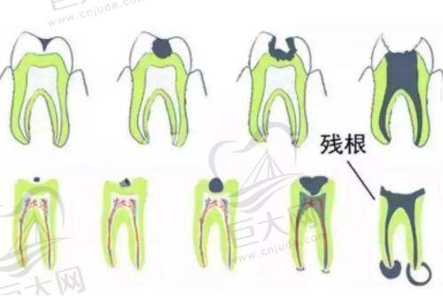 主打项目之吸脂及脂肪填充
