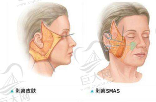 鼻翼改小项目及收费