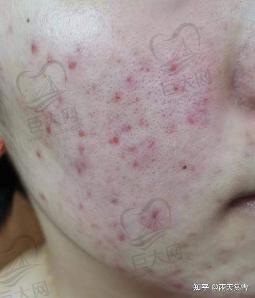 长春皮肤科医生大揭秘:刘禹杉、于之龙等多位名医助你解决皮肤过敏、痘痘难题