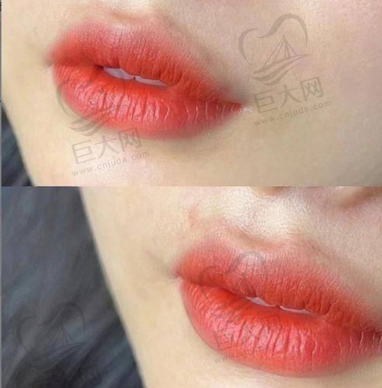 眼部吸脂项目及收费