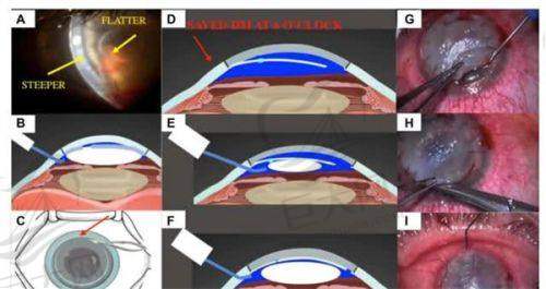 段安丽后巩膜加固术手术价格：单眼2万元起，依病情和术式调整，且术后10年眼轴稳定率达85%