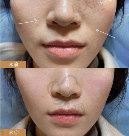 韩国玻尿酸价格现状