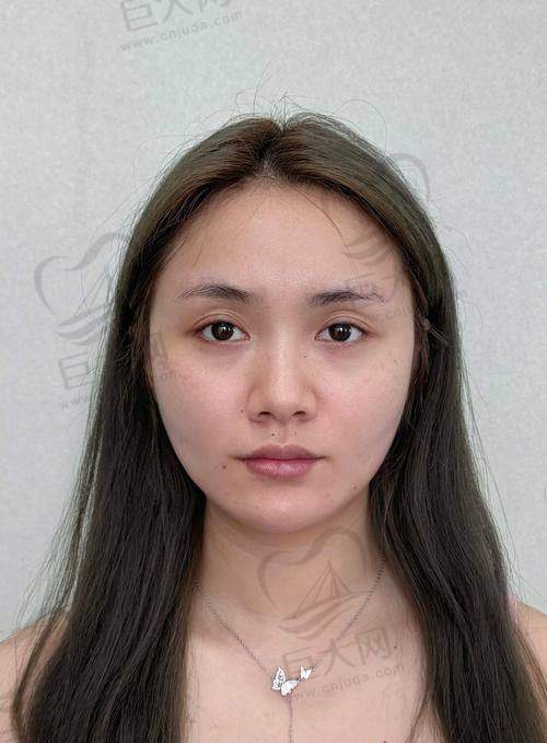 选择韩国打玻尿酸的注意事项