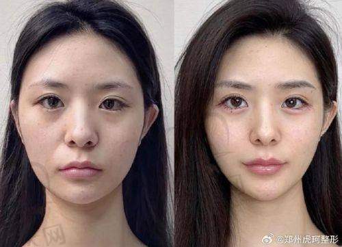 韩国玻尿酸产品优势