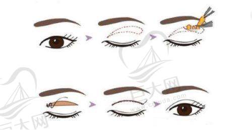 云南昆明华美美莱整形眼眉整形收费价格:双眼皮、眼袋修复及特色项目费用参考,眼修复约10000-30000元等