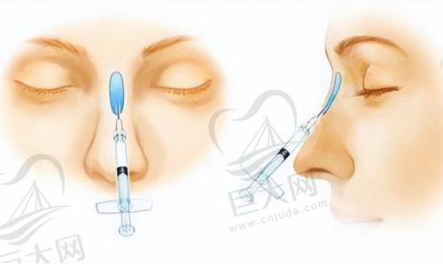 深圳鹏程整形医院注射整形收费价格:国产瘦脸460元起,乔雅登雅致玻尿酸4320元起,濡白天使15800元起