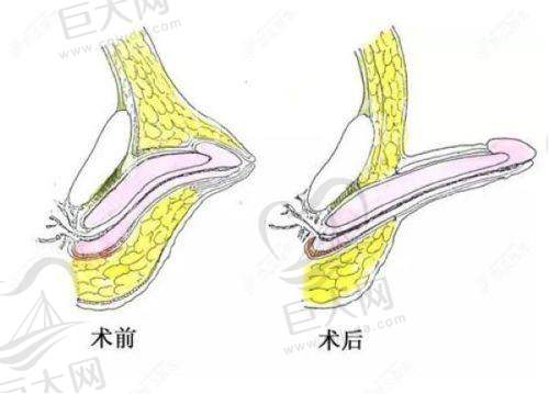 上海虹桥医院疤痕科疤痕整形收费价格：按位置面积计算，疤痕疙瘩修复16000元起，凹陷性疤痕修复14000元起