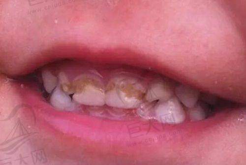 上海罗缘口腔门诊部获患者好评4.6分（满分5），医生技术好收费合理，种牙低至1.28万起