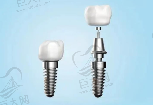 半口全口种植牙6年后的稳定性和耐用性如何