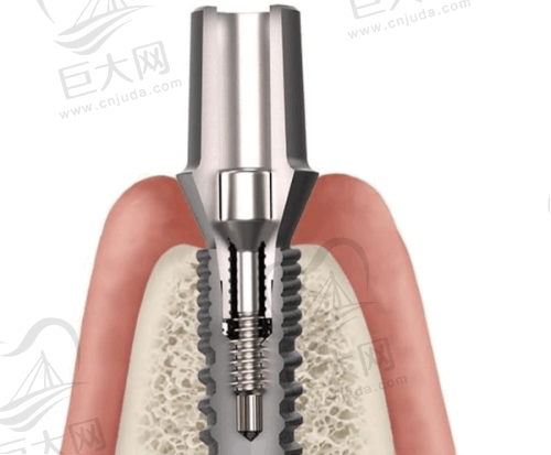 2025年成人牙齿正畸价格走势