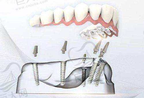 普通牙套和自锁牙套的矫正成效哪个更佳