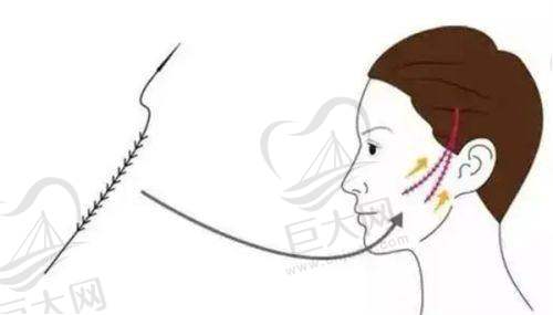 南京洪志坚医生鼻修复技术