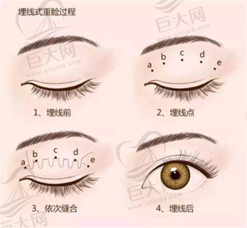 大连爱德丽格医疗美容眼眉整形收费价格:埋线、切开、三点定位双眼皮及开眼角等项目参考价公布,可预约刘志刚院长