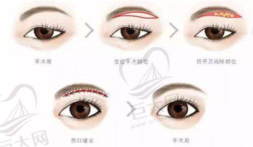 徐国建隆胸医生技术如何?做双平面假体丰胸效果佳,恢复快且疤痕小值得关注