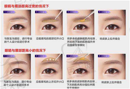 西安画美整形医院面部提升收费价格：蓝钻逆时光埋线9800 - 23800元，热玛吉面部19800元