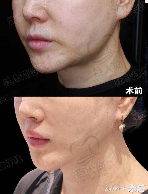 韩国医美必做项目价格表——皮肤管理项目