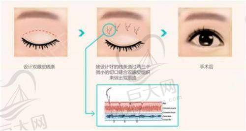 2025年知名整形医院双眼皮价格表大揭秘:成都、杭州、深圳多地权威医生与机构价格及技术全解析