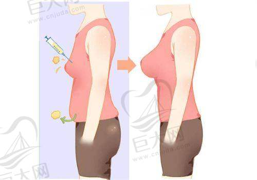 上海时光整形隆胸价格是多少?傲若拉星熠假体隆胸价格19800元到150000元左右,可约张嘉林/李静林/张晶医生